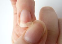 Ломкие ногти на руках: причины, лечение
