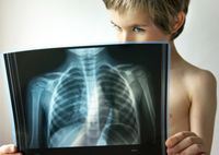 Симптомы атипичной пневмонии у детей и ее лечение