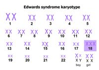 Синдром Эдвардса: клинические проявления и возможности терапии
