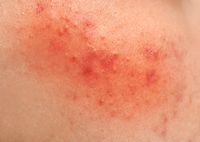 Что такое пероральный дерматит на лице и как его лечат