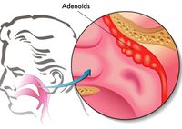Как делается аденотомия – удаление аденоидов у детей