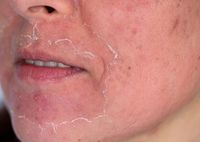 Причины и лечение красных пятен на лице