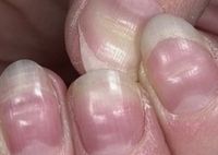 Почему возникают вмятины на ногтях