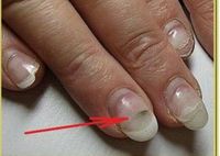 Причины и лечение плесени на ногтях после наращивания