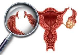 Показания и методы проведения стерилизации женщин