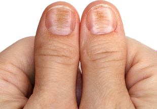 Причина и лечение дистрофии ногтя