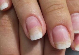 Ониходистрофия ногтей у женщин