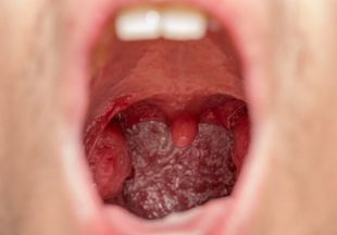 Увеличены миндалины у ребенка в горле