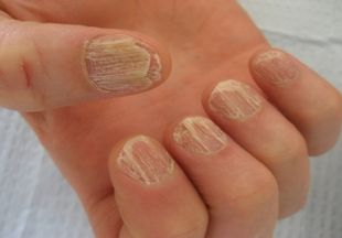 Деформация ногтей на руках: причины, лечение