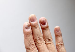 Причины и лечение волнистых ногтей на руках