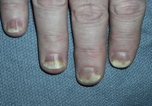 Болят ногти на руках: причины и что делать