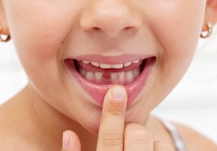 Удаление молочных зубов у детей: проведение и возможные осложнения