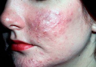Симптомы и лечение подкожного клеща на лице
