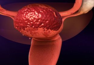 Какие боли бывают при эндометриозе и как с ними бороться