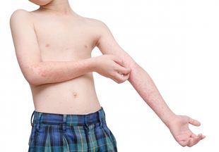 Аллергия на руках у взрослых и детей
