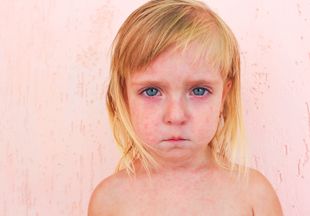 Вирусная экзантема у детей: признаки и терапия