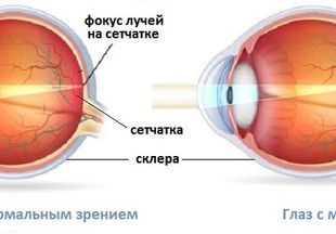 Операция склеропластики глаз у детей как метод лечения близорукости