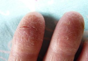 Причины глубоких трещин на пальцах рук, и методы их лечения