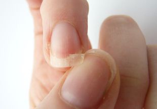 Ломкие ногти на руках: причины, лечение