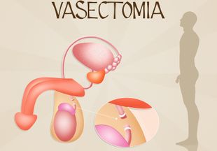 Как проводится вазэктомия