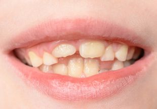 Кривые зубы у детей: причины, лечение и профилактика