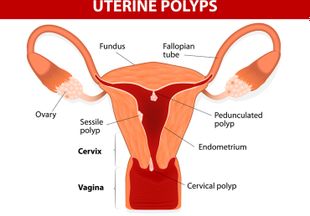 Симптомы и лечение плацентарного полипа после родов