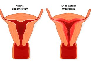 Какой должна быть нормальная толщина эндометрия