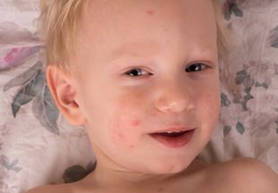 Как проявляется аллергия на сладкое у детей и как ее лечить