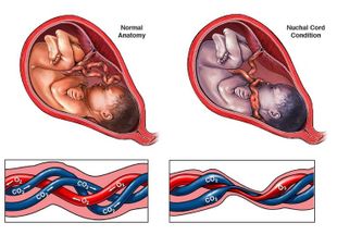 Короткая пуповина при родах: причины, осложнения и устранение