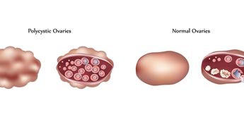 Что такое мультифолликулярные яичники и надо ли с этим бороться