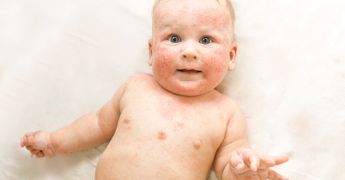 Как выглядит аллергия на лице у грудничка, методы лечения