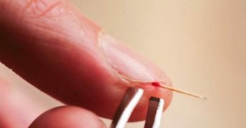 Извлечение занозы из-под ногтя в домашних условиях
