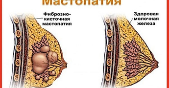 Фиброзно-кистозная мастопатия: симптомы и лечение