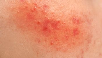 Что такое пероральный дерматит на лице и как его лечат