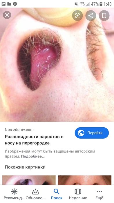 Девочки успокоиться не могу, в носу какой то отек или шишка.
