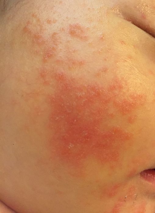 Аллергия у грудничка 1,5 месяца