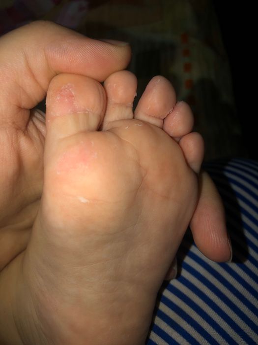 Облазит кожа на пальцах ног у ребёнка