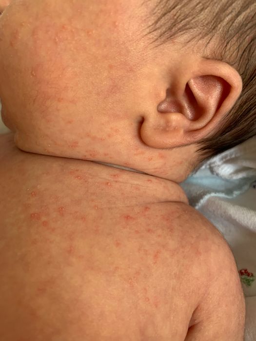 Акне новорожденных или аллергия, а может потница?