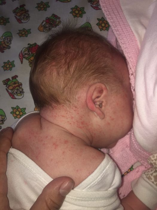 Аллергия, потничка или гормональная сыпь новорожденных?