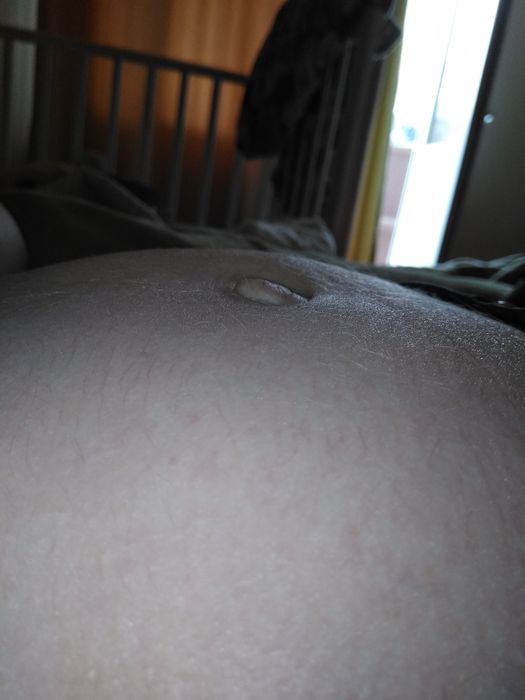 Диастаз в беременность, режет в районе пупка