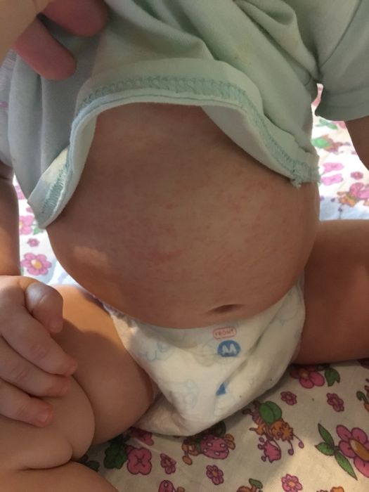 Аллергия на детский нурофен