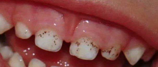 Черные точки на зубах надо лечить?