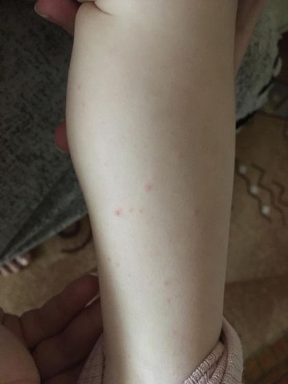 Сыпь