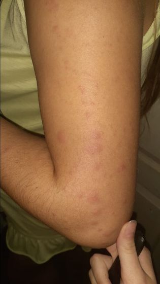 Sos ❗❗❗Клопы Девочки приехала