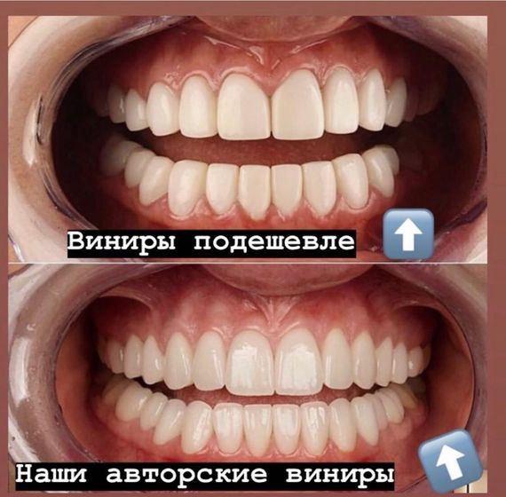 У кого Виниры?покажите