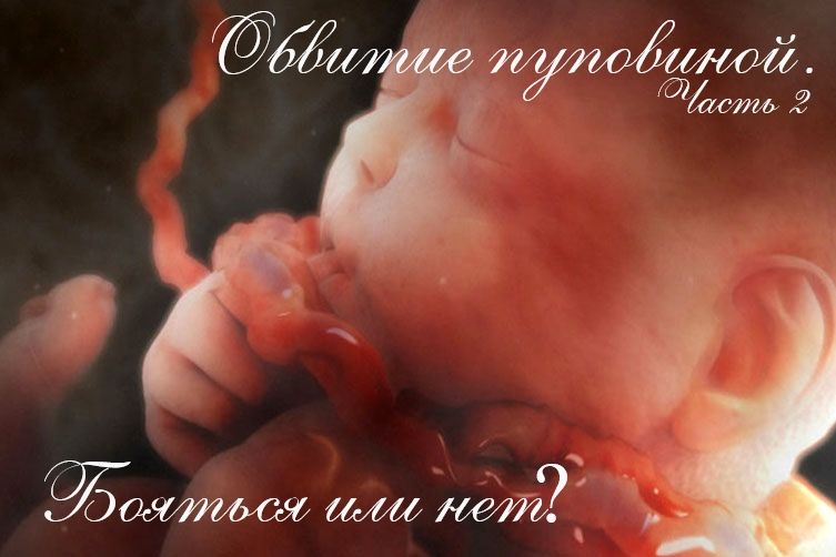 Обвитие пуповинной. Бояться или нет? Часть 2