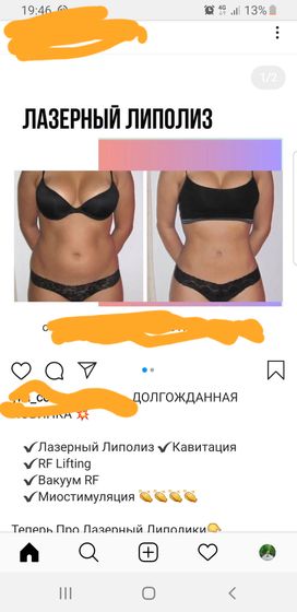 Лазерный липолиз