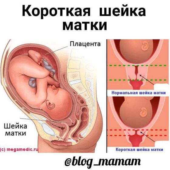 Короткая шейка. 33 неделя беременности.