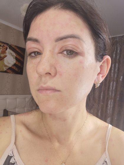Аллергия на апельсин 10 неделя