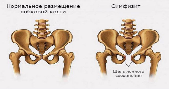 Результаты 1 скрининга и симфизит
